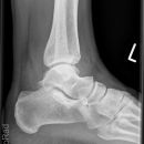 Snowboard fracture Talus