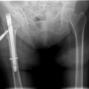 Schlecht festgeschraubt