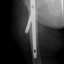 Schlecht festgeschraubt