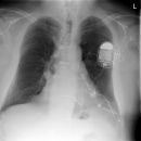 Sunshine C-Pulse Device