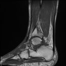 Snowboard fracture Talus