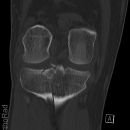 Tibiakopffraktur (nicht disloziert)