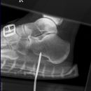 Birkenstockrefixation