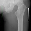 Cam FAI mit herniation pit