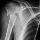 Dislozierte subcapitale Fraktur mit Tbc majus