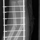 Unterarmschaft Fraktur