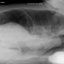 Freie Luft Linksseitenlage