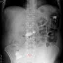 Fremdkörper verschluckt