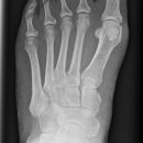 Fuß_ap Belastung.jpg