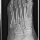 Fuß schräg chir.jpg