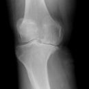 Gonarthrose