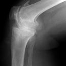 Gonarthrose