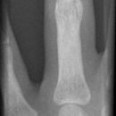 Grundgliedköpfchenfraktur