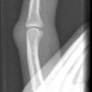 Grundgliedköpfchenfraktur