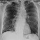 Infarktpneumonie bei Trikuspidalklappenendokarditis