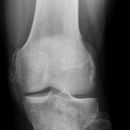 Intraossäres Hämangiom