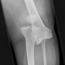 Traumatische Luxation