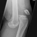 Traumatische Luxation