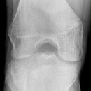 Knöcherner Ausriss Patellarsehne