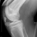 Knöcherner Ausriss Patellarsehne