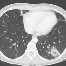 Lungenabszess