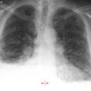 Lungenfibrose DD atypische Infiltrate