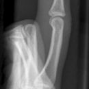 Mittelgliedbasisfraktur