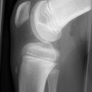 Morbus Osgood Schlatter li