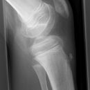 Morbus Osgood Schlatter li