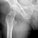 Nichtdislozierte Sitzbeinfraktur