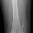 Osteochondrom