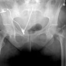 pertrochantäre Femurfraktur