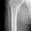 pertrochantäre Femurfraktur