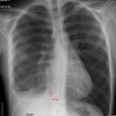 Pleuraabszess bei Trichterbrust OP