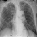 Pneumothorax liegend