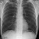 Pneumothorax rechts apikal
