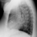 Sarkoidose Stadium I