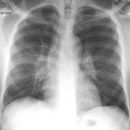 Sarkoidose Stadium II