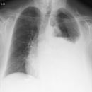 Seropneu Mediastinalshift