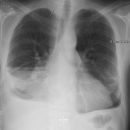 Seropneumothorax 2 Ebenen