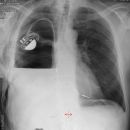 Serothorax nach Pneumektomie