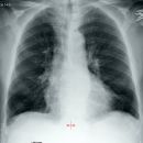 Stauung mit Kerley Linien