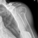 Subcapitale Fraktur und Tuberculum majus