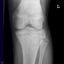 Tibiakopf 16 Jahre alt