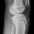 Tibiakopf 16 Jahre alt