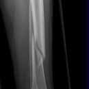 Spiralfraktur Tibia