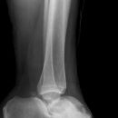 Totale Talusluxation