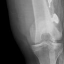 Traumatische Epiphysenlösung