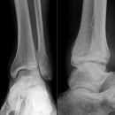 Weber C + dorsales Volkmann