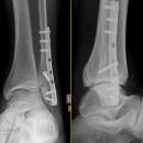 Weber C + dorsales Volkmann